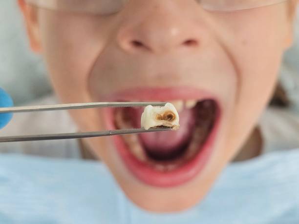 Best Emergency Wisdom Teeth Removal in Washington, KS